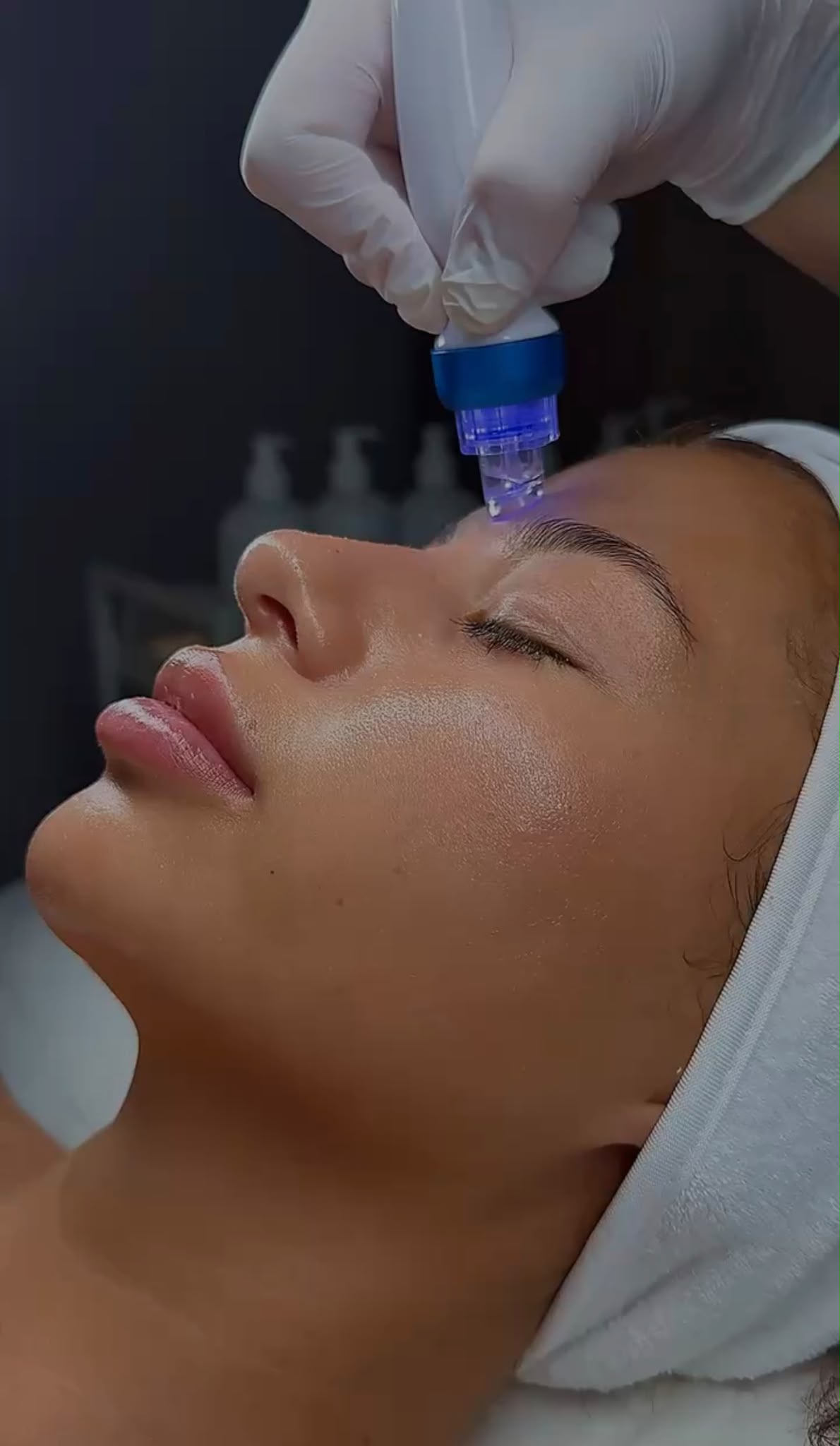 Microneedling-Behandlung im heybelle Studio